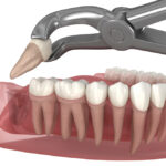 wisdom tooth removal